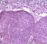 皮肤肿物，表皮内见部分细胞成团，大小较一致，可见核分裂像图6