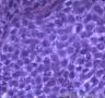 皮肤肿物，表皮内见部分细胞成团，大小较一致，可见核分裂像图1