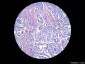 经典病例学习-膀胱尿路上皮癌伴鳞状和腺状分化图8
