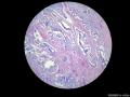 经典病例学习-膀胱尿路上皮癌伴鳞状和腺状分化图5