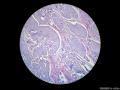 经典病例学习-膀胱尿路上皮癌伴鳞状和腺状分化图4