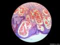 经典病例学习-血管角皮瘤图3