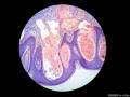 经典病例学习-血管角皮瘤图5