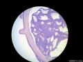 经典病例学习-小汗腺汗孔瘤图2