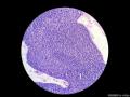 经典病例学习-小汗腺汗孔瘤图14