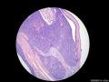 经典病例学习-小汗腺汗孔瘤图11