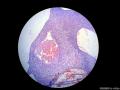 经典病例学习-小汗腺汗孔瘤图10