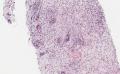 第二届华夏病理学术论坛:泌尿生殖系统病例1(黄教悌老师提供,天山望月大会发言)图19