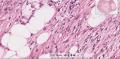第二届华夏病理学术论坛:乳腺病理病例4(王曦老师提供,三石大会发言)图17