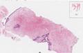 第二届华夏病理学术论坛:乳腺病理病例2(王曦老师提供,abin大会发言)图6