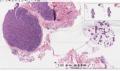 第二届华夏病理学术论坛:乳腺病理病例3(王曦老师提供,八戒大会发言)图2