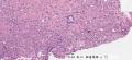第二届华夏病理学术论坛:乳腺病理病例1(王曦老师提供,嘎子哥大会发言)图9