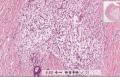 第二届华夏病理学术论坛:乳腺病理病例4(王曦老师提供,三石大会发言)图3