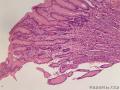胃窦病变性质待查图13