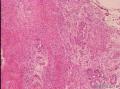 卵巢腺癌，浆乳、宫内膜样腺癌？图9