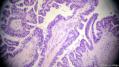 经典病例学习-卵巢交界性浆液性囊腺瘤图11