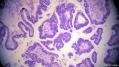 经典病例学习-卵巢交界性浆液性囊腺瘤图9
