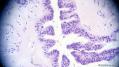 经典病例学习-卵巢交界性浆液性囊腺瘤图21