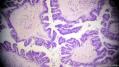 经典病例学习-卵巢交界性浆液性囊腺瘤图20