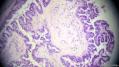 经典病例学习-卵巢交界性浆液性囊腺瘤图18