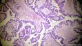 经典病例学习-卵巢交界性浆液性囊腺瘤图5