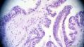 经典病例学习-卵巢交界性浆液性囊腺瘤图19