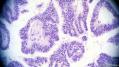 经典病例学习-卵巢交界性浆液性囊腺瘤图10