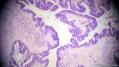 经典病例学习-卵巢交界性浆液性囊腺瘤图12
