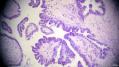 经典病例学习-卵巢交界性浆液性囊腺瘤图16