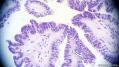 经典病例学习-卵巢交界性浆液性囊腺瘤图17