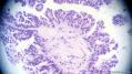 经典病例学习-卵巢交界性浆液性囊腺瘤图15