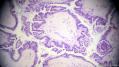 经典病例学习-卵巢交界性浆液性囊腺瘤图2