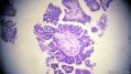 经典病例学习-卵巢交界性浆液性囊腺瘤图8
