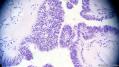 经典病例学习-卵巢交界性浆液性囊腺瘤图14