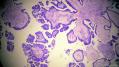 经典病例学习-卵巢交界性浆液性囊腺瘤图7