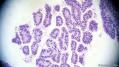 经典病例学习-卵巢交界性浆液性囊腺瘤图13