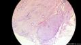 经典病例学习-胆管高分化腺癌图28