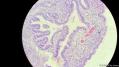 经典病例学习-胆管高分化腺癌图18