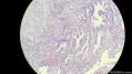 经典病例学习-胆管高分化腺癌图16