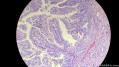 经典病例学习-胆管高分化腺癌图14
