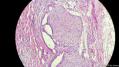 经典病例学习-胆管高分化腺癌图30