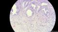 经典病例学习-胆管高分化腺癌图19