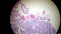 经典病例学习-胆管高分化腺癌图5