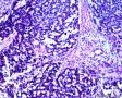 食管肿瘤附IHC,基底细胞鳞癌或腺样囊性癌，如何解读IHC?求教分析图8