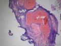 发现盆腔肿瘤2月图3