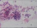 宫颈刮片  女  43岁。急求帮助图2