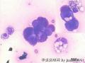 解释一下：“国外病例，稍后公布答案：Ascites cytology, 34-year old female，positive for adenocarcinoma图2