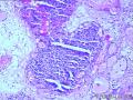 请看膀胱乳头状肿瘤报什么，固有膜内组织是内翻还是有浸润？图15