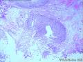 请看膀胱乳头状肿瘤报什么，固有膜内组织是内翻还是有浸润？图3