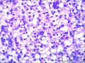 子宫肿物（透明细胞平滑肌瘤？）图6